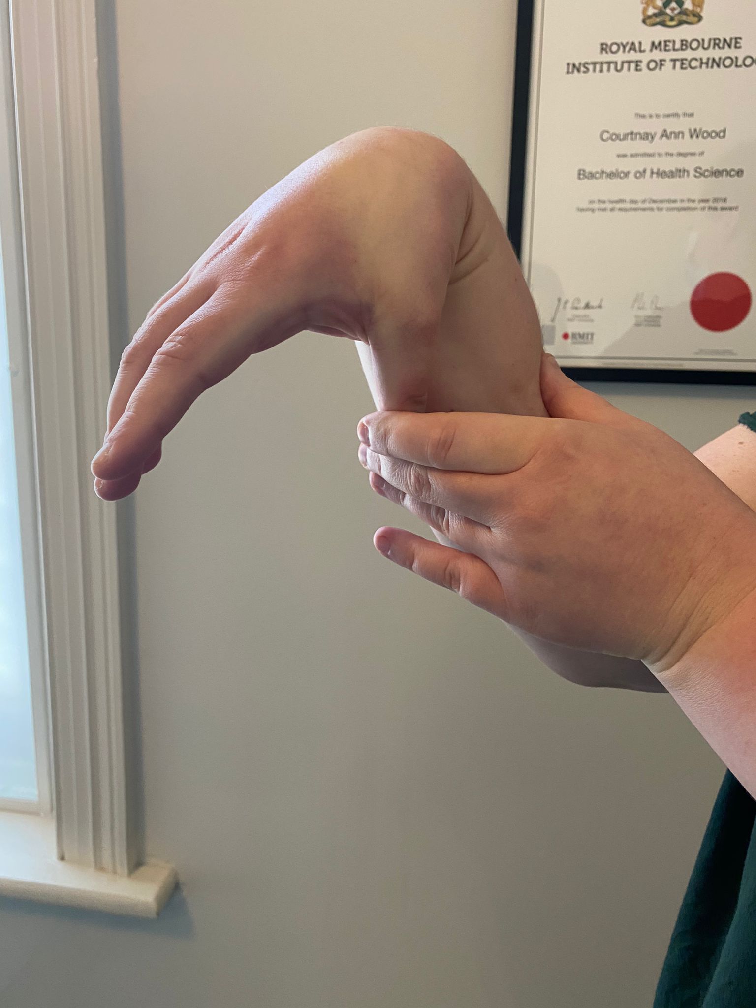 Beighton score hypermobility hand and wrist pain resilient health osteopath and chiropractic